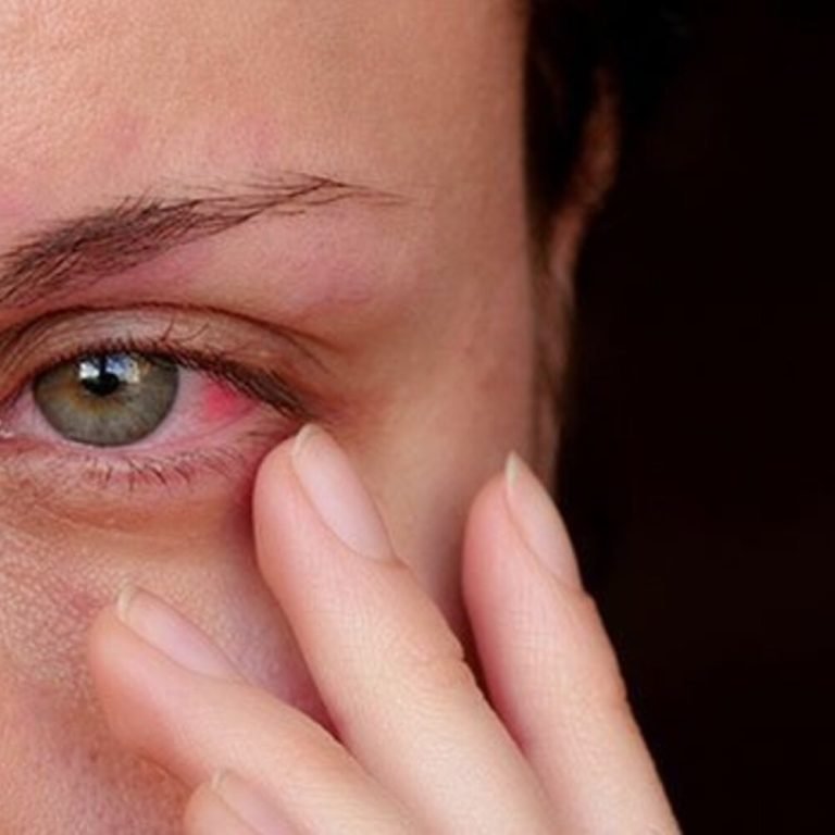 conjunctivitis 1 editor (1)