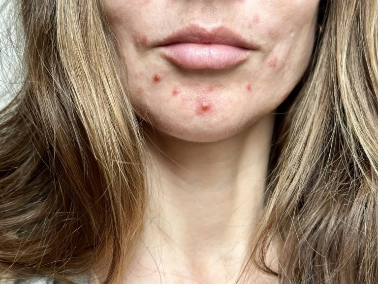 close-up-of-chin-on-female-face-with-acne-2025-02-24-16-07-59-utc (1)