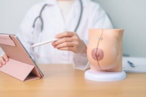 Doctor with Breast Anatomy model. Breast Augmentation Surgery, O